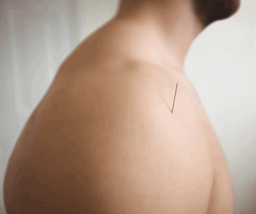 Dry Needling Olive Physio