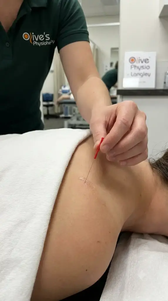 Close-up of dry needling needles used in physiotherapy treatment at Olive Physio in Langley